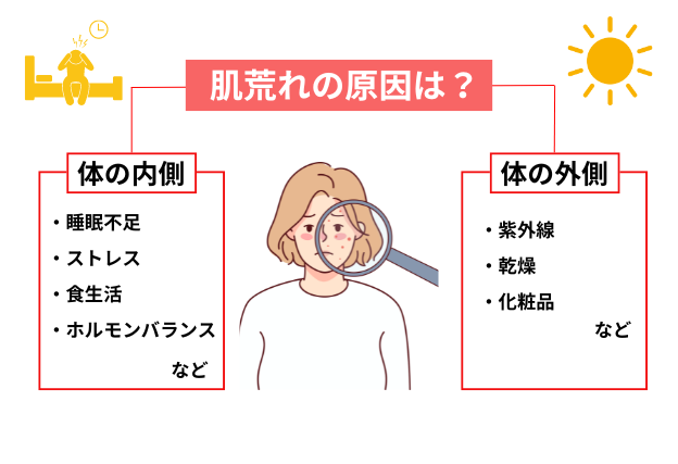 肌荒れの原因は体内(睡眠不足、ストレス、食生活、加齢)と体外(紫外線、乾燥、化粧品)にあります